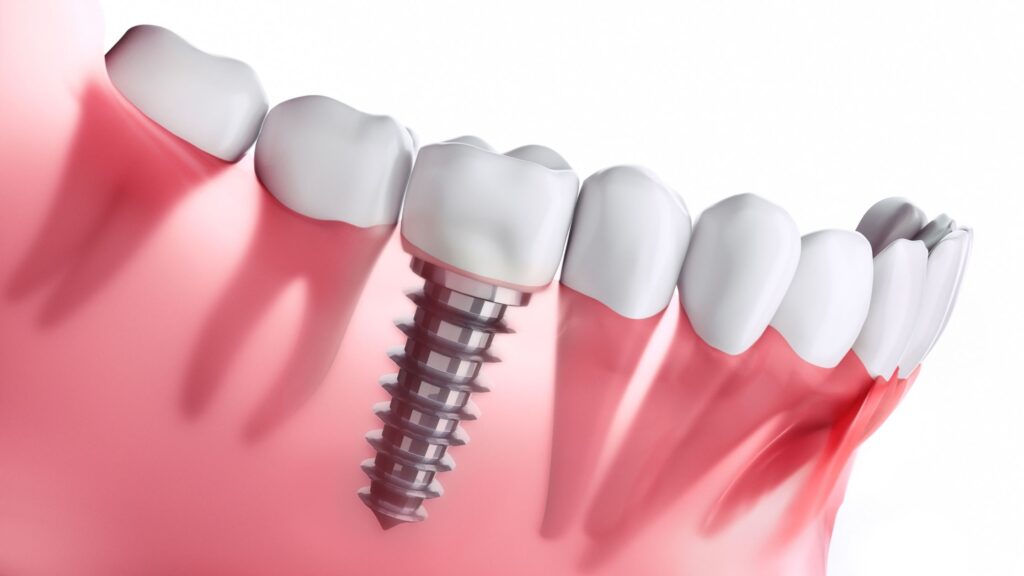 Dental Implants cost