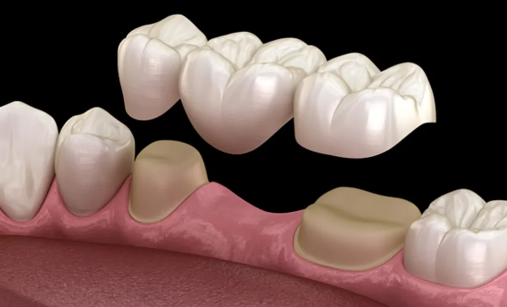 Dental crowns