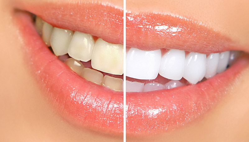 Teeth Whitening Treatment