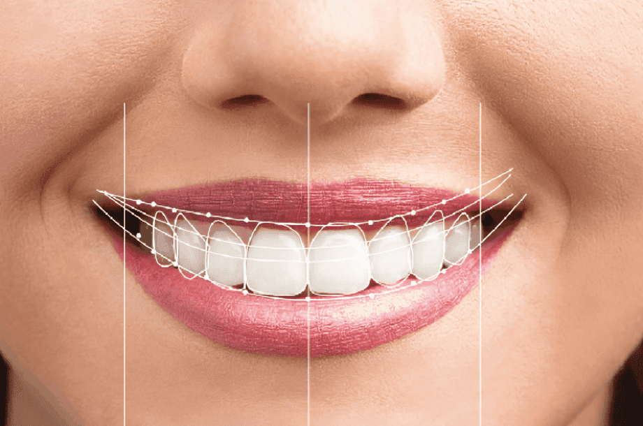 Smile Makeover Treatment at NJ dental Space