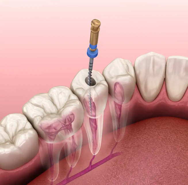 Root Canal Treatment