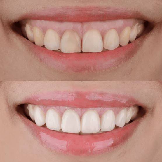 Smile Makeover - NJ Dental Space