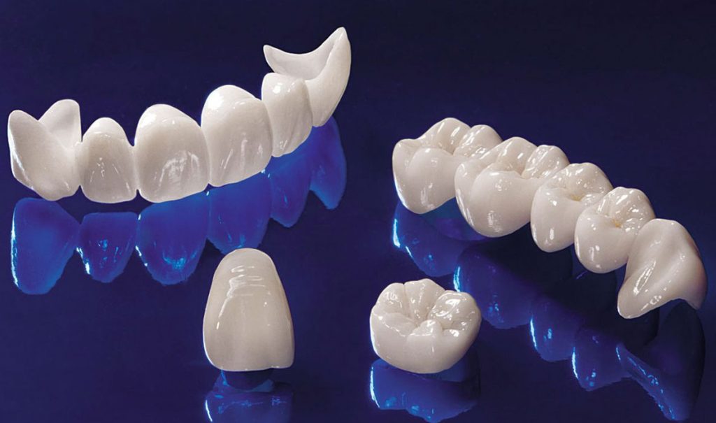 Dental crowns - nj dental space